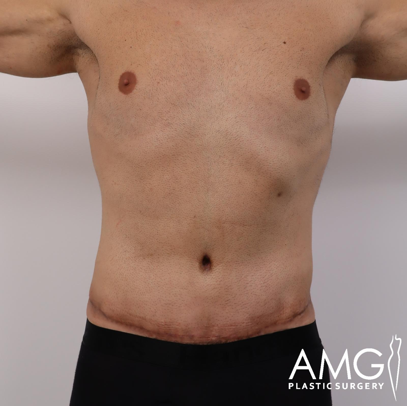 Front view of a man's abdomen after tummy tuck showing a flatter and more contoured abdomen, AMG Plastic Surgery.