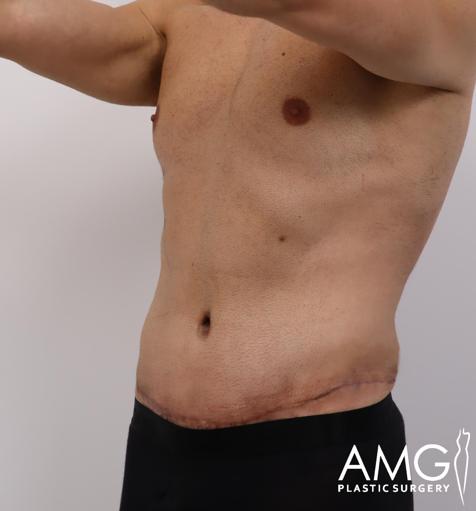Left oblique view of a man's abdomen after tummy tuck showing a flatter and more contoured abdomen, AMG Plastic Surgery.