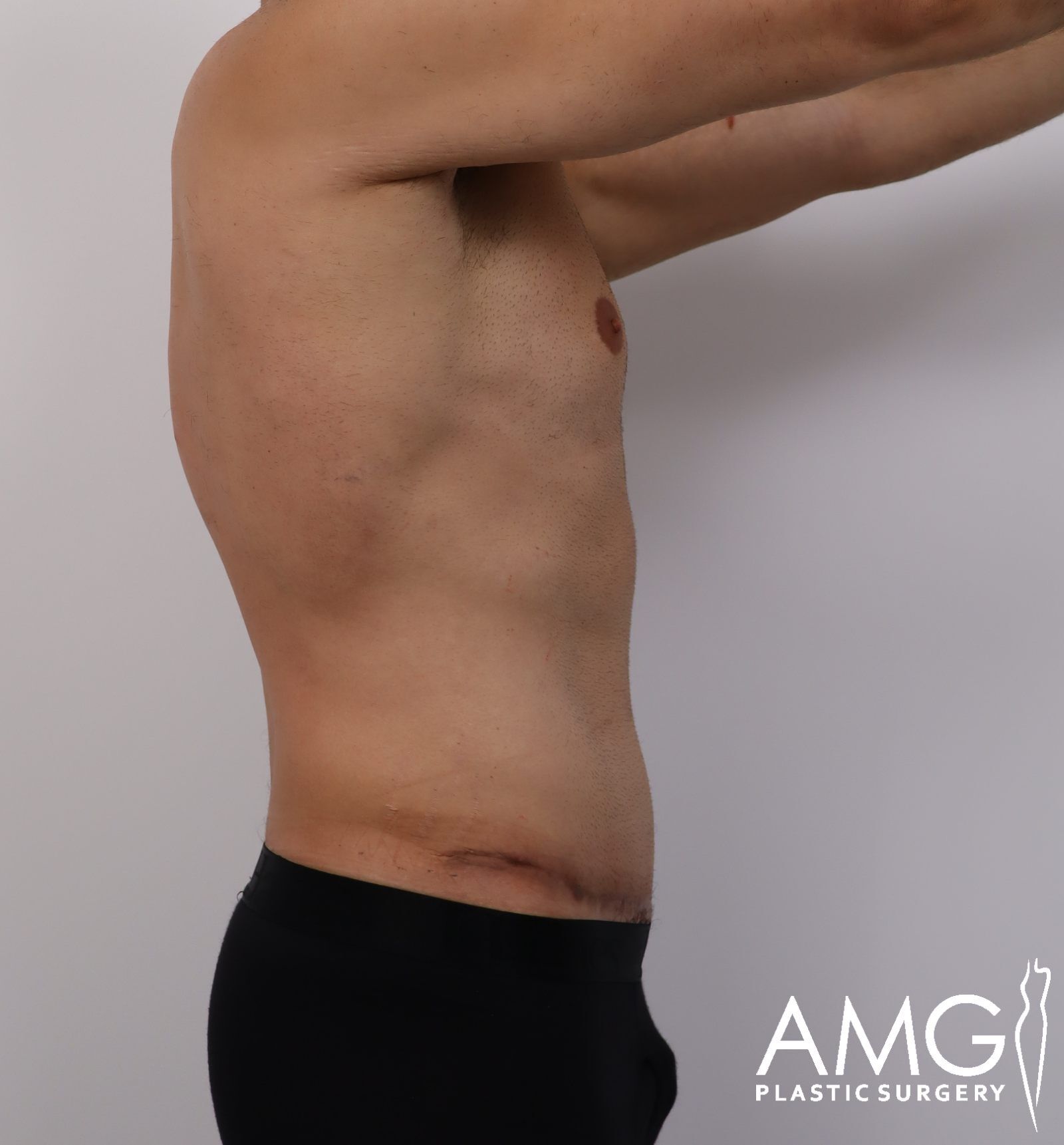 Right view of a man's abdomen after tummy tuck showing a flatter and more contoured abdomen, AMG Plastic Surgery.