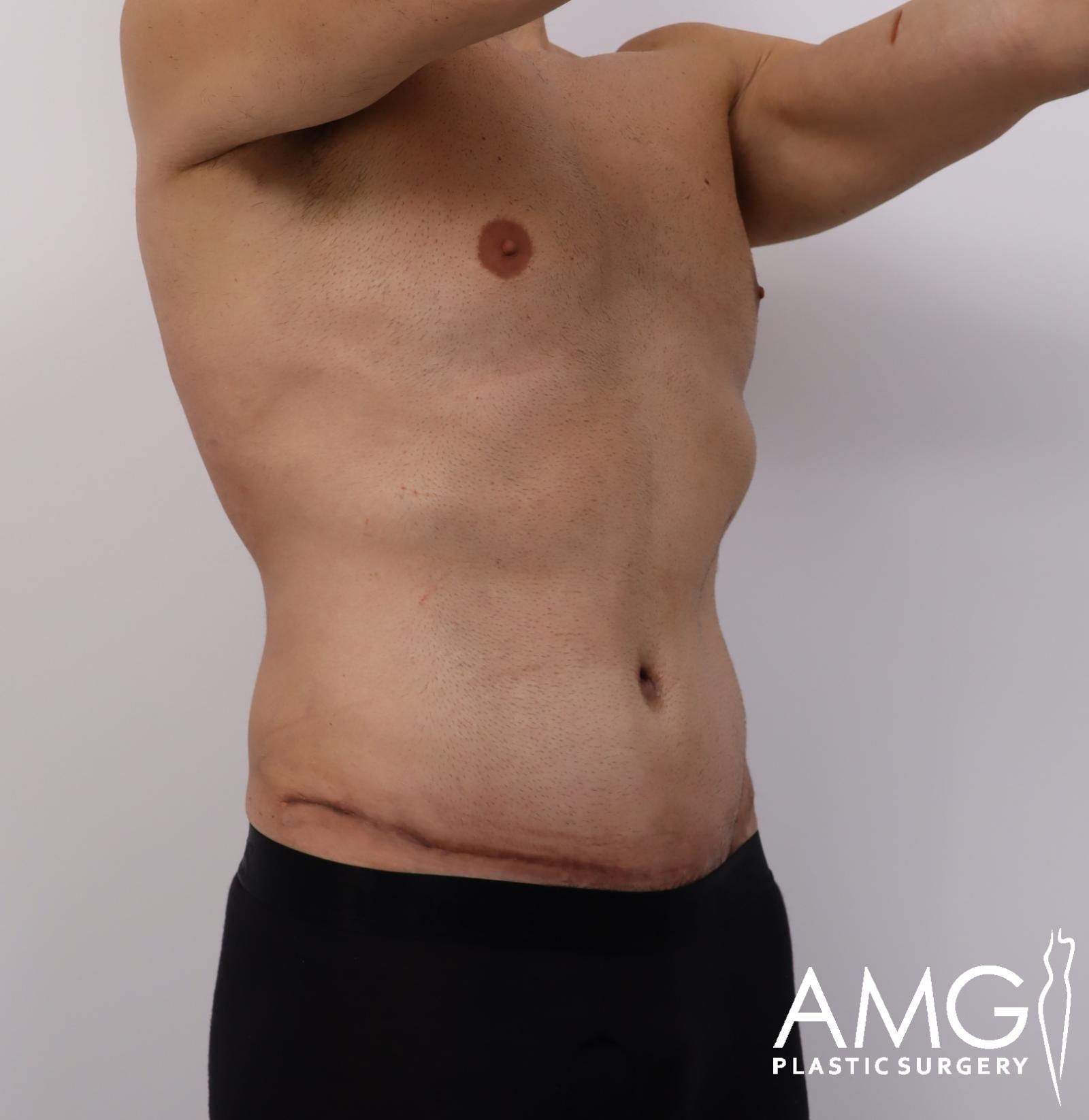 Right oblique view of a man's abdomen after tummy tuck showing a flatter and more contoured abdomen, AMG Plastic Surgery.
