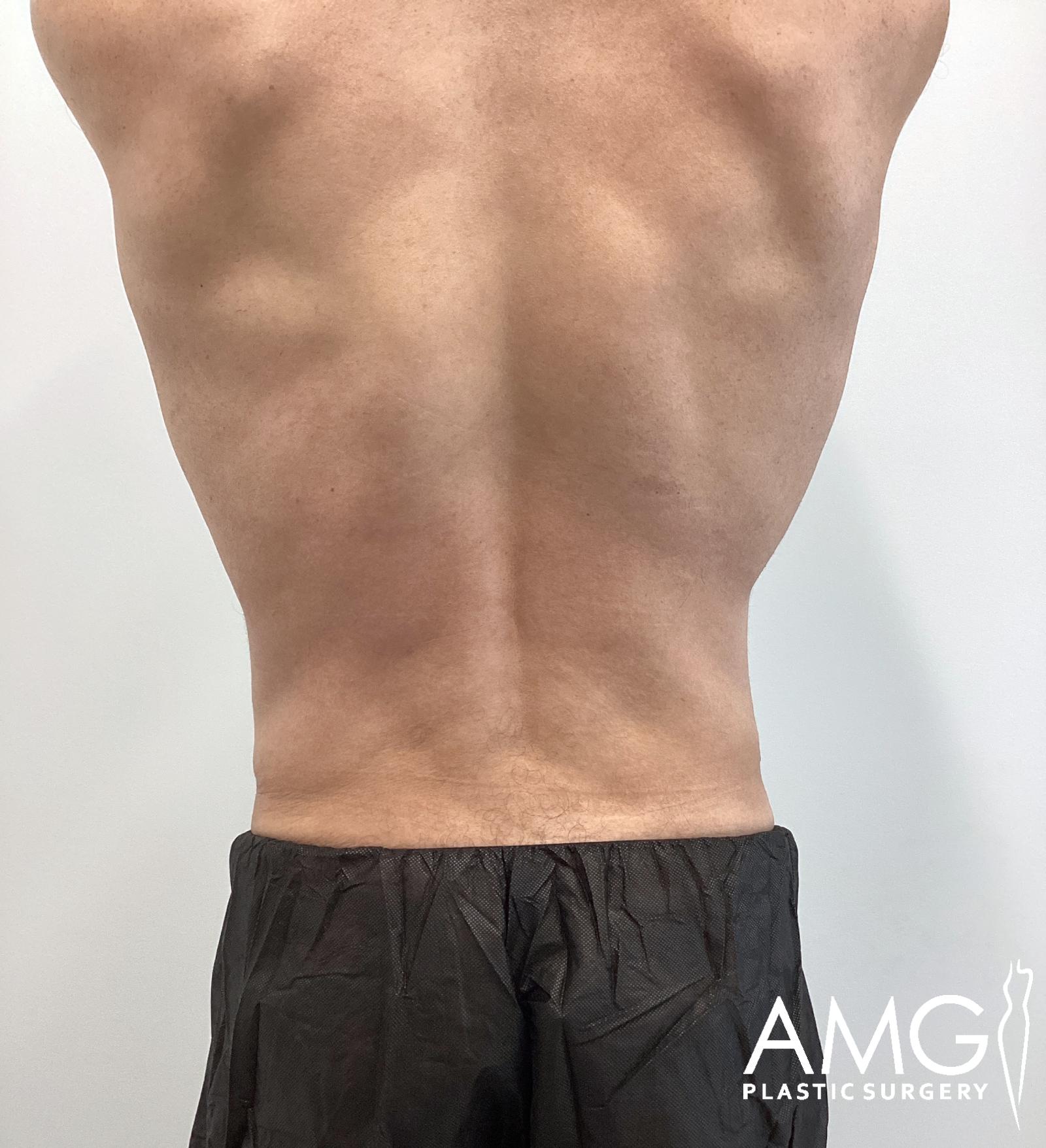 Back view of a man's abdomen before tummy tuck showing excess skin and lax abdominal contour, AMG Plastic Surgery.
