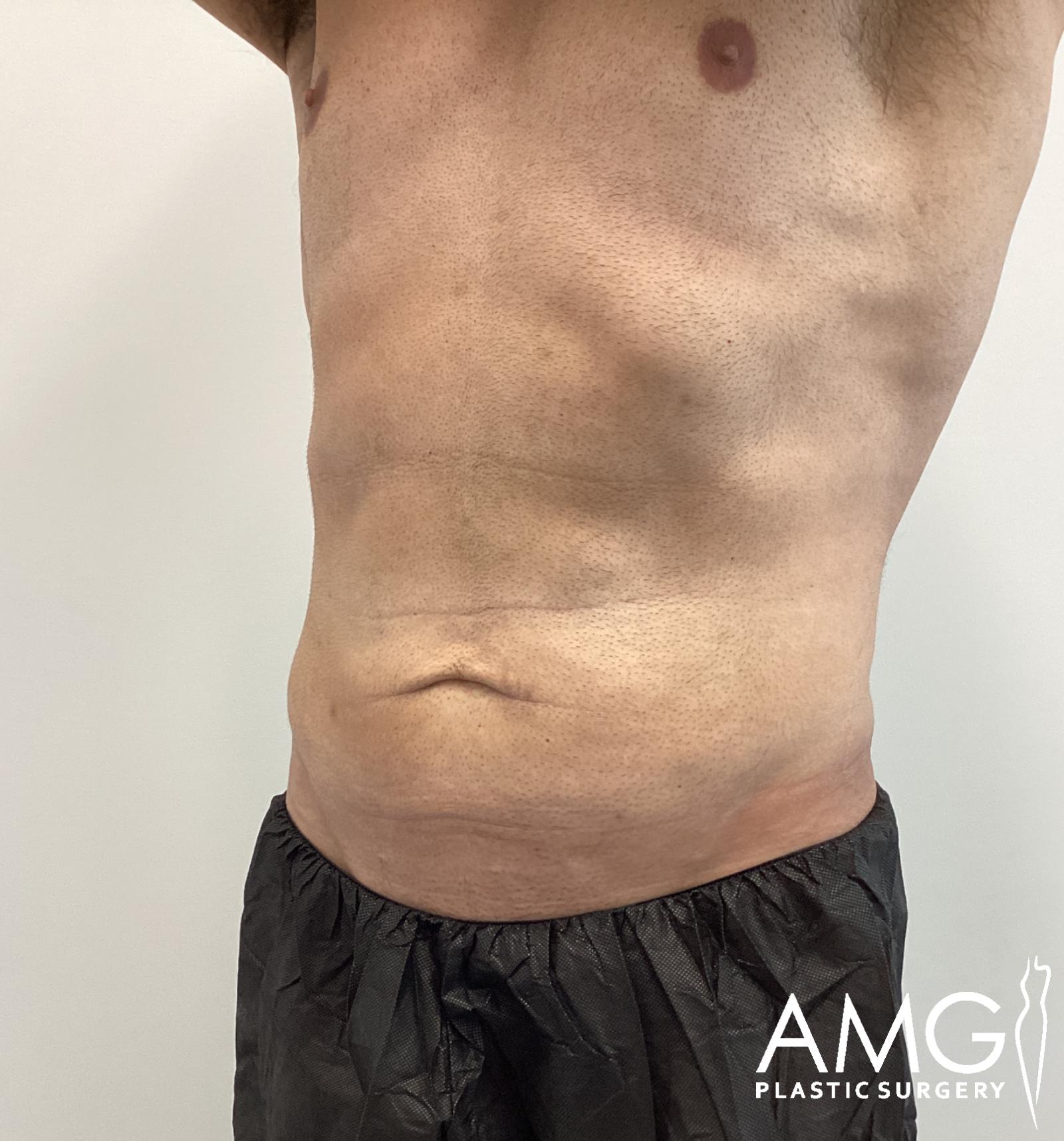Left oblique view of a man's abdomen before tummy tuck showing excess skin and lax abdominal contour, AMG Plastic Surgery.