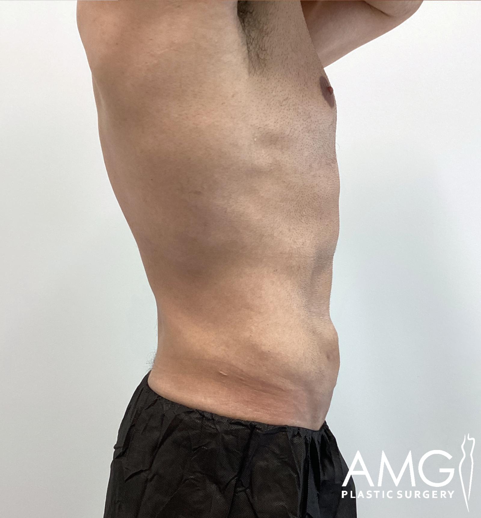 Right view of a man's abdomen before tummy tuck showing excess skin and lax abdominal contour, AMG Plastic Surgery.