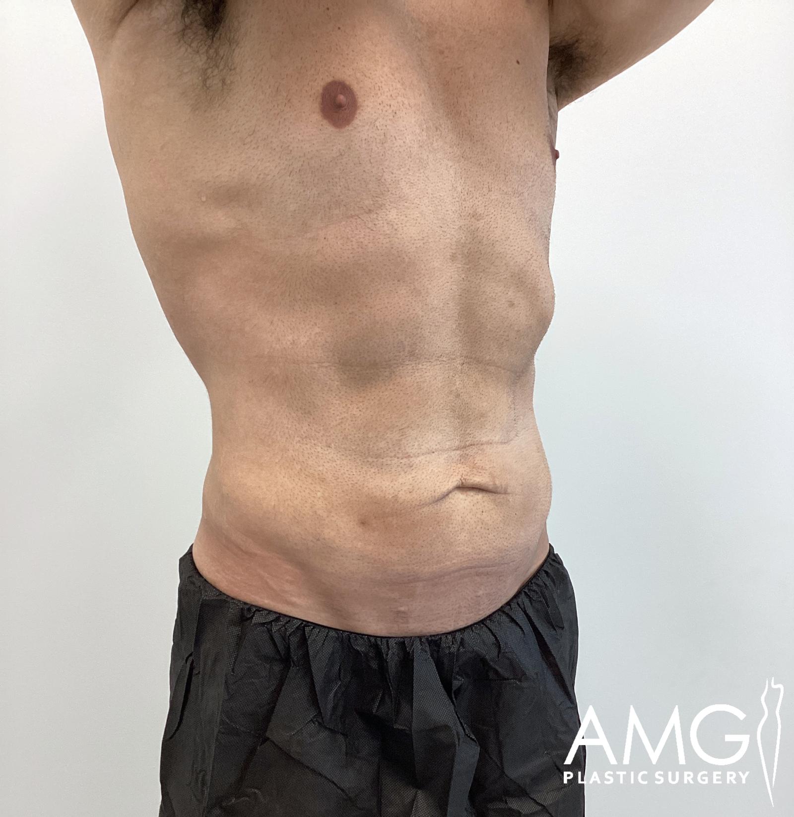 Right oblique view of a man's abdomen before tummy tuck showing excess skin and lax abdominal contour, AMG Plastic Surgery.