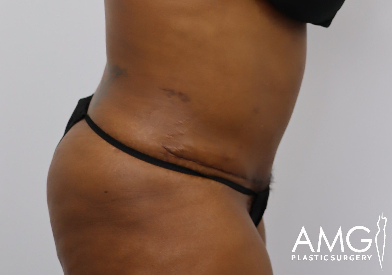 Tummy tuck after surgery – right side view improved abdominal contour, AMG Plastic Surgery