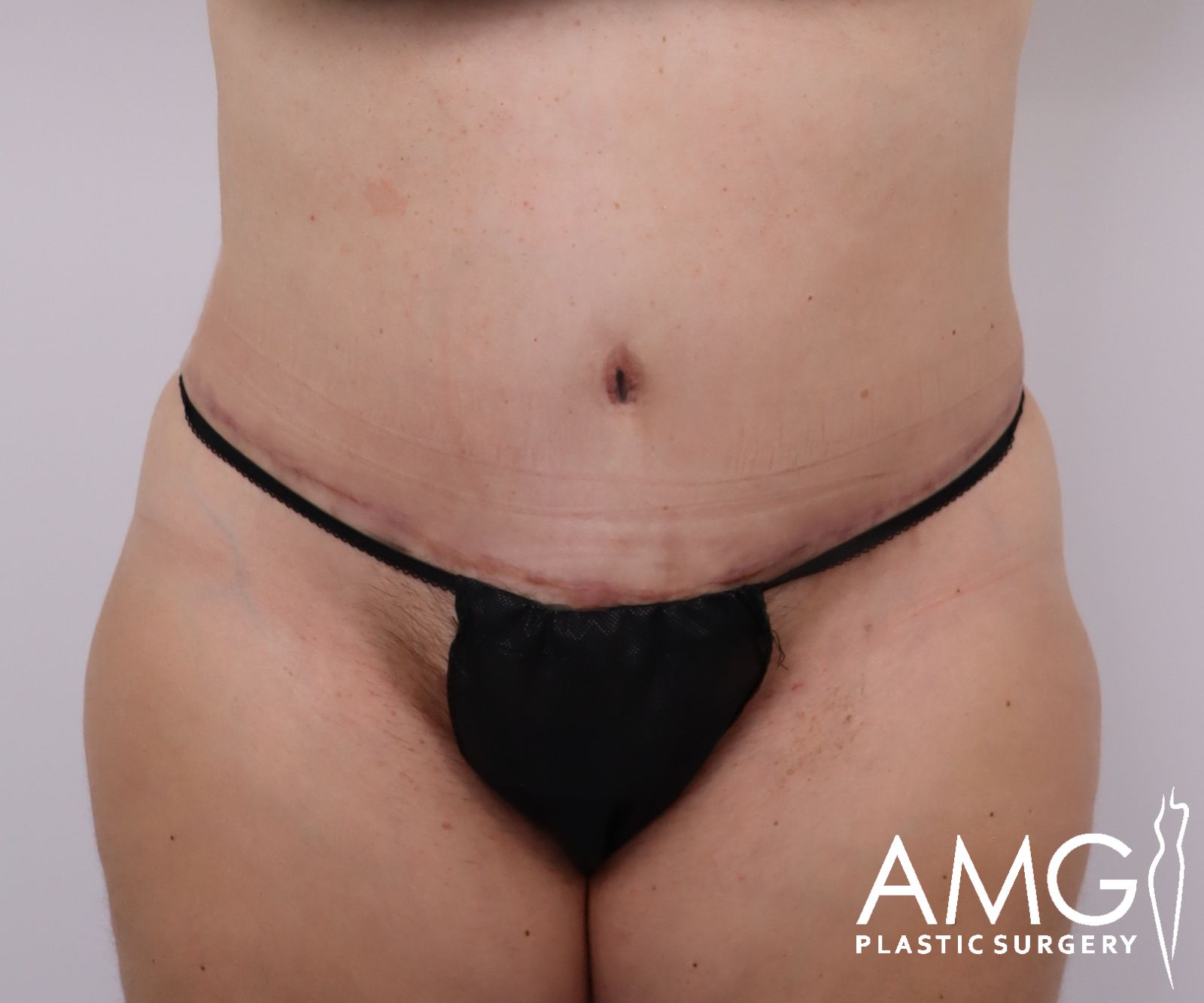 Abdomen after tummy tuck surgery – front view, AMG Plastic Surgery