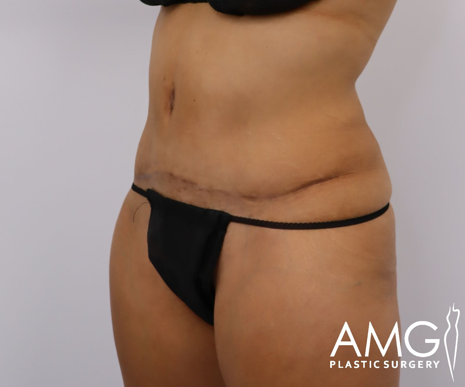 Abdomen after tummy tuck surgery – left oblique view, AMG Plastic Surgery