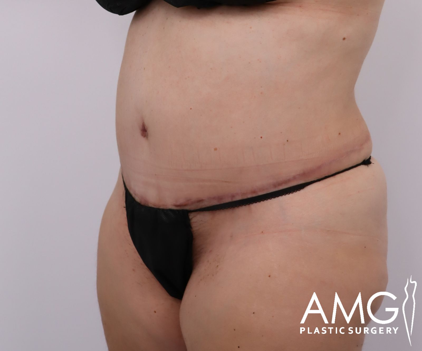 Abdomen after tummy tuck surgery – left oblique view, AMG Plastic Surgery