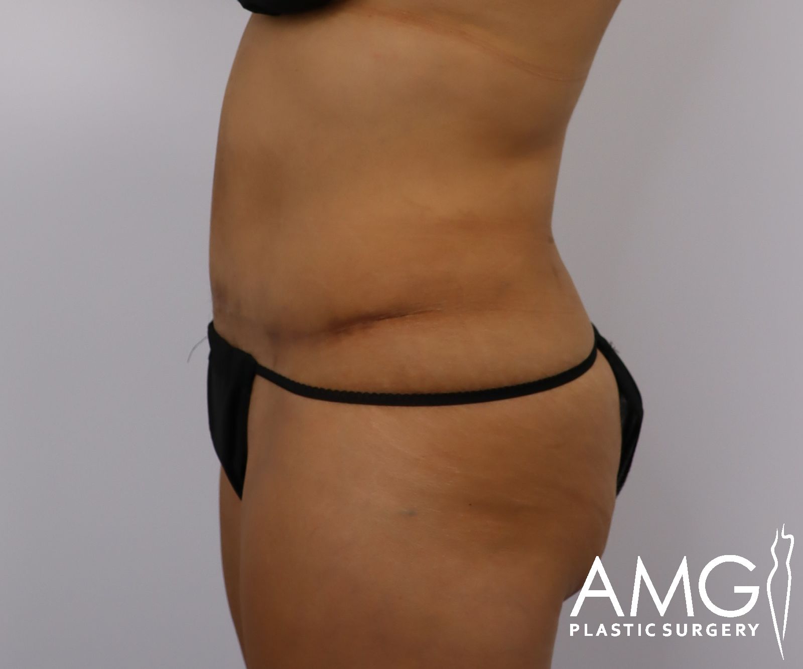 Abdomen after tummy tuck surgery – left side view, AMG Plastic Surgery