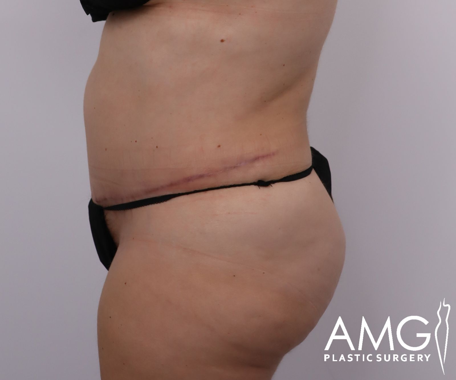 Abdomen before tummy tuck surgery – left side view, AMG Plastic Surgery