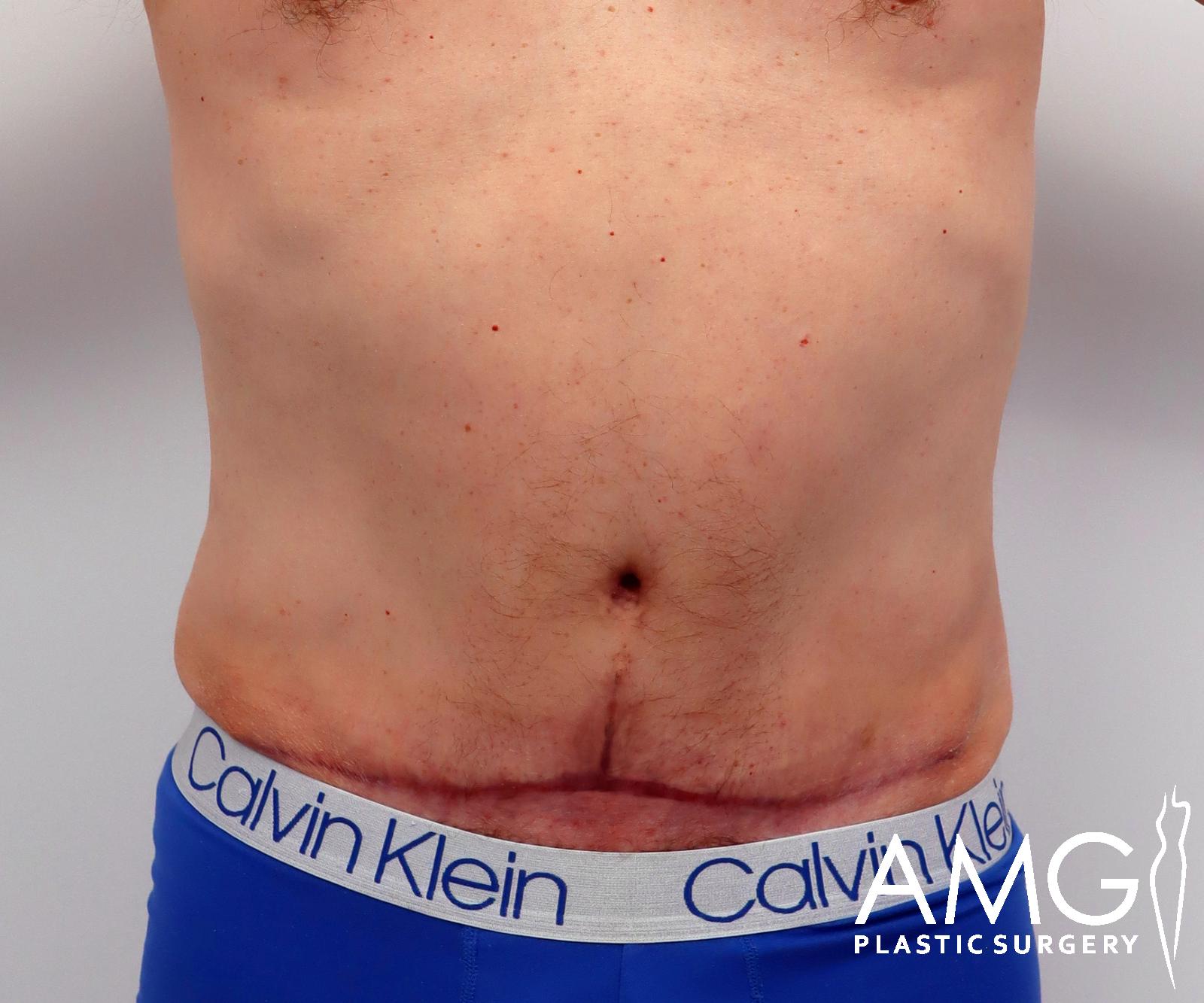 Abdomen after tummy tuck surgery – front view, AMG Plastic Surgery