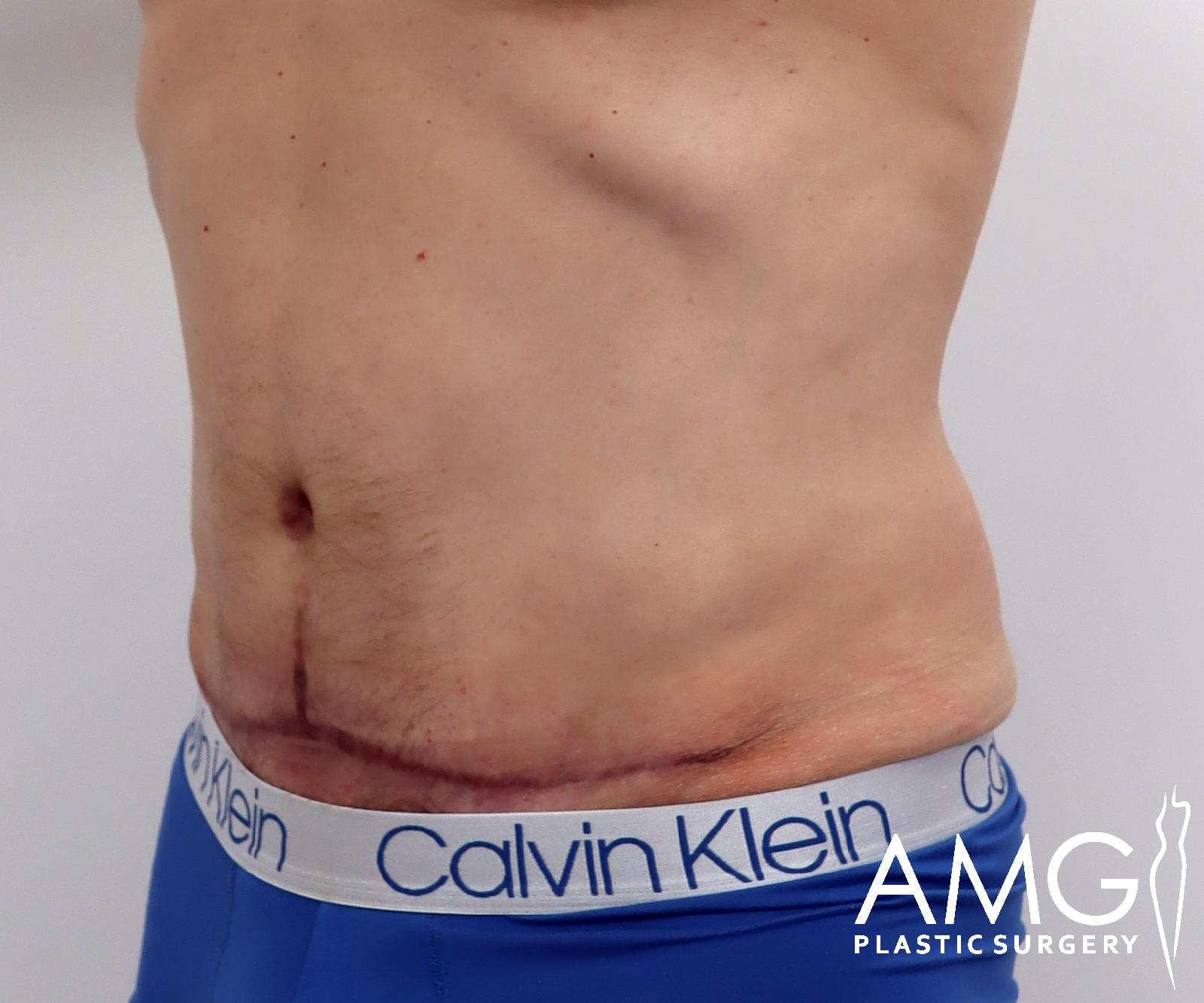 Abdomen after tummy tuck surgery – left oblique view, AMG Plastic Surgery