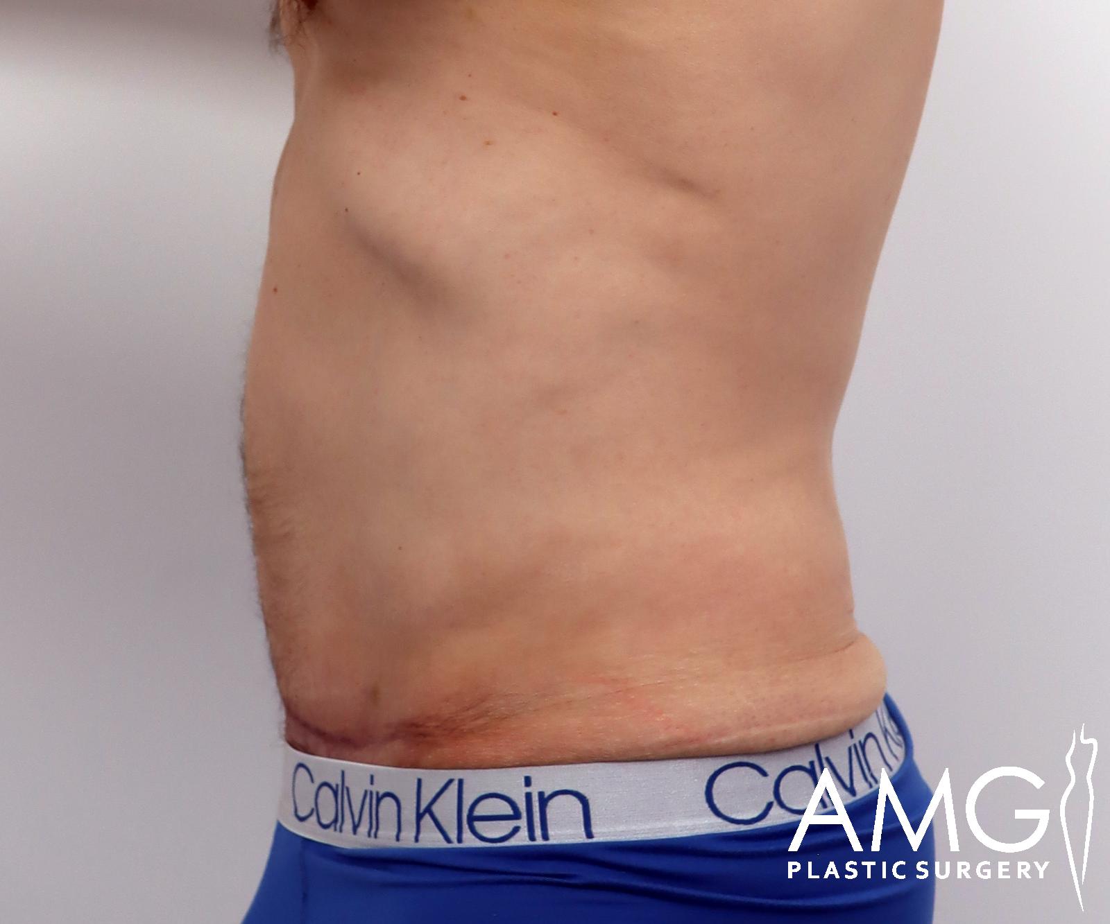 Abdomen after tummy tuck surgery – left side view, AMG Plastic Surgery
