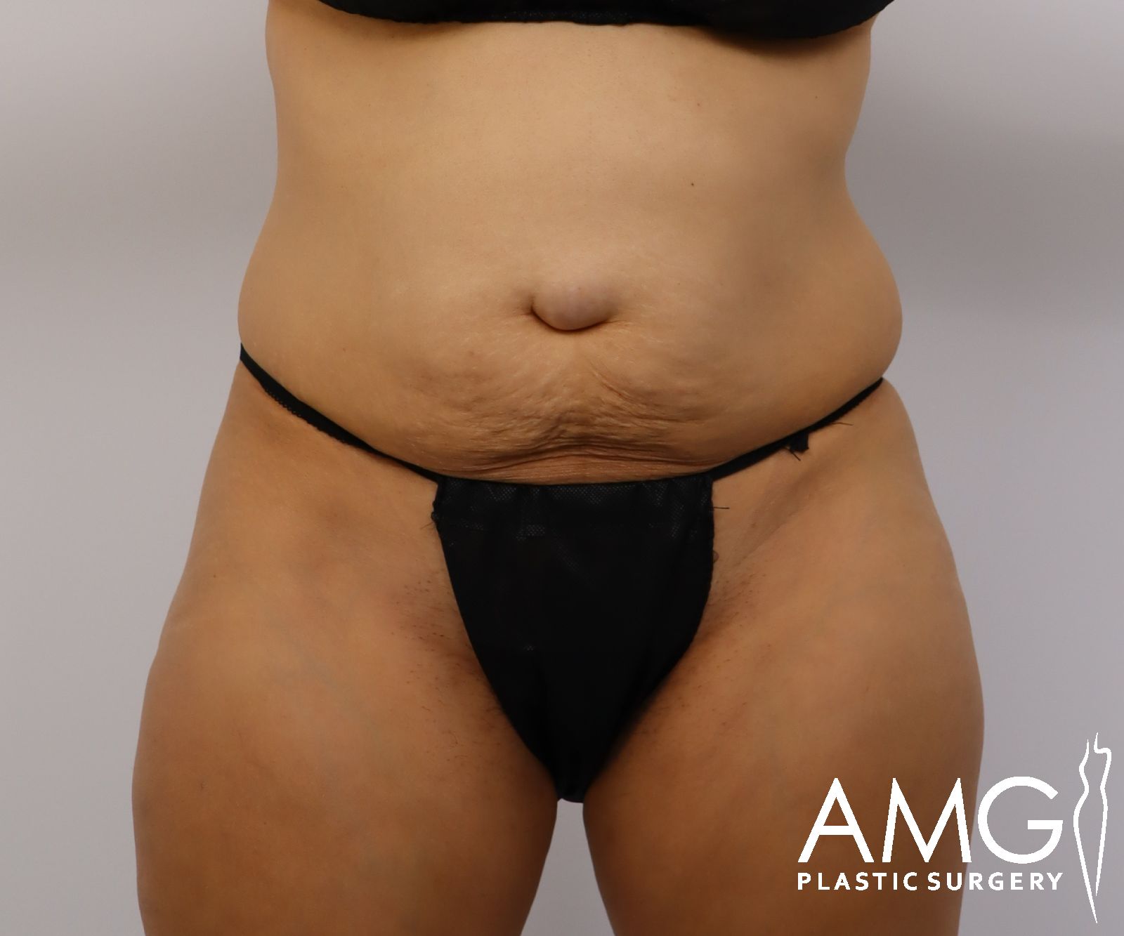 Abdomen before tummy tuck surgery – front view, AMG Plastic Surgery