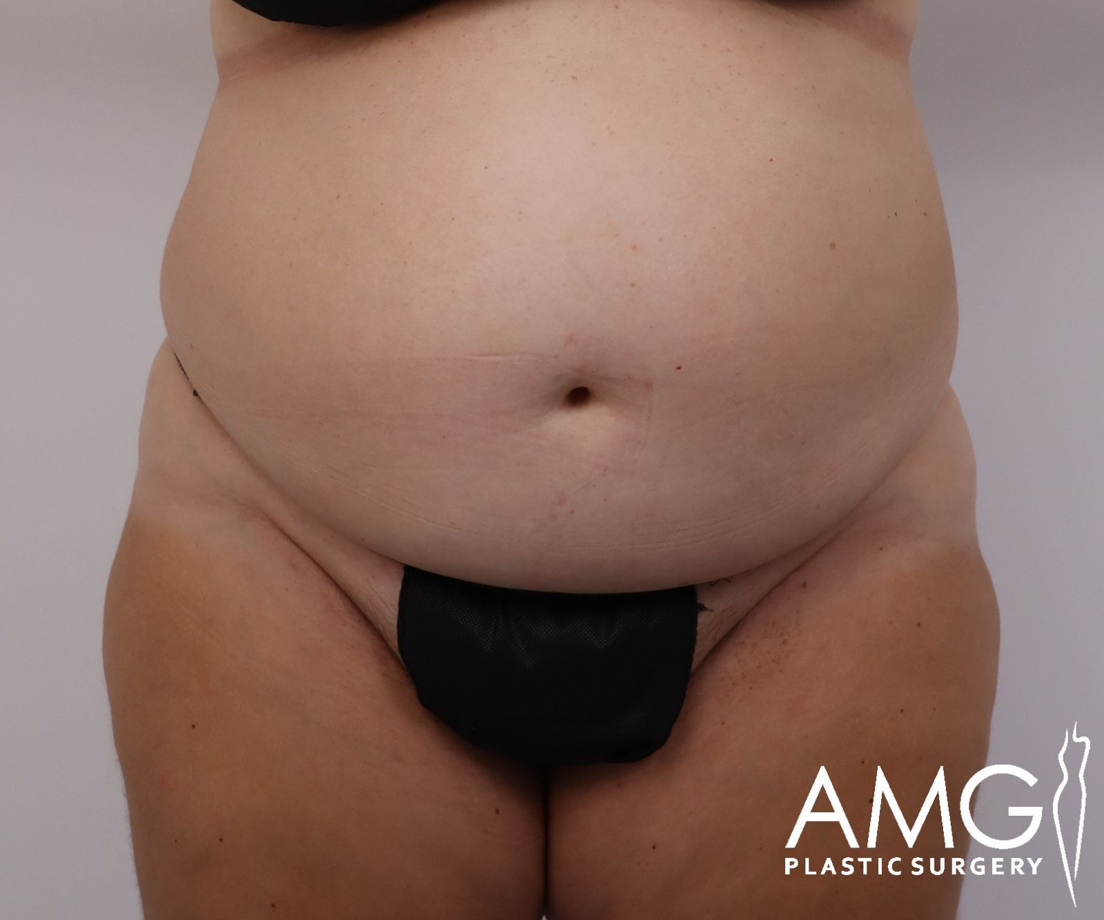 Abdomen before tummy tuck surgery – front view, AMG Plastic Surgery