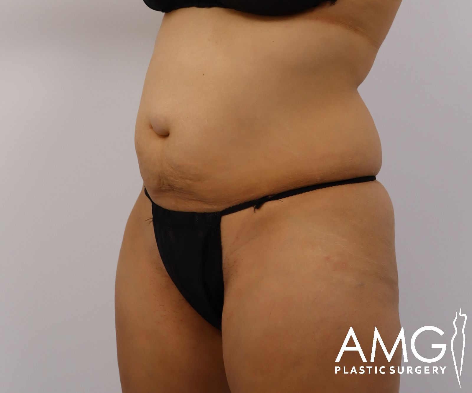 Abdomen before tummy tuck surgery – left oblique view, AMG Plastic Surgery