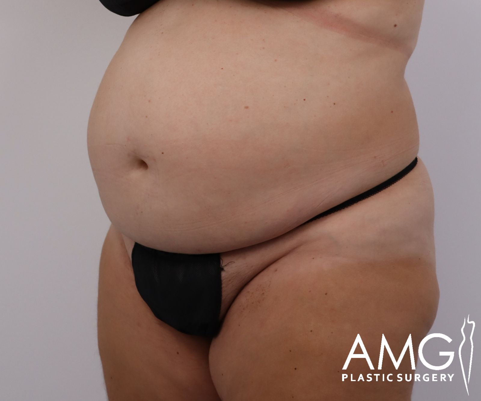 Abdomen before tummy tuck surgery – left oblique view, AMG Plastic Surgery