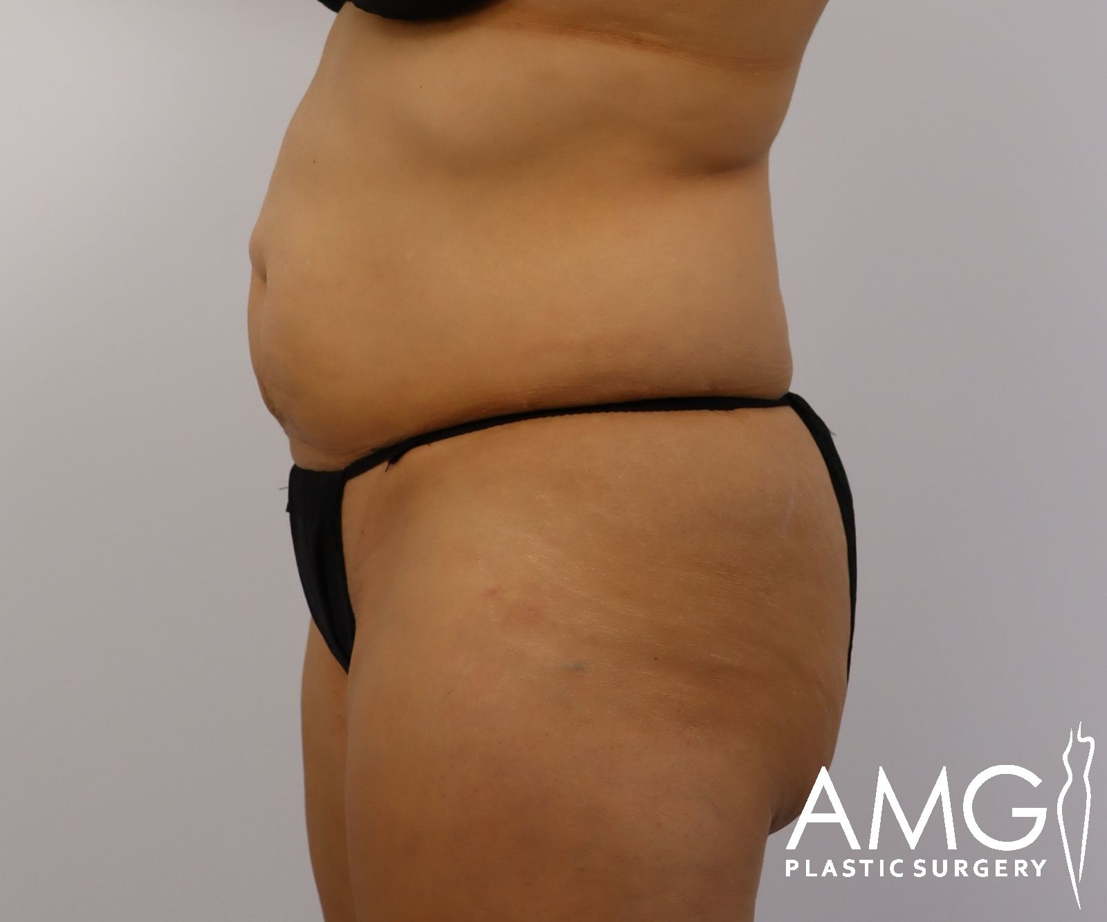 Abdomen before tummy tuck surgery – left side view, AMG Plastic Surgery