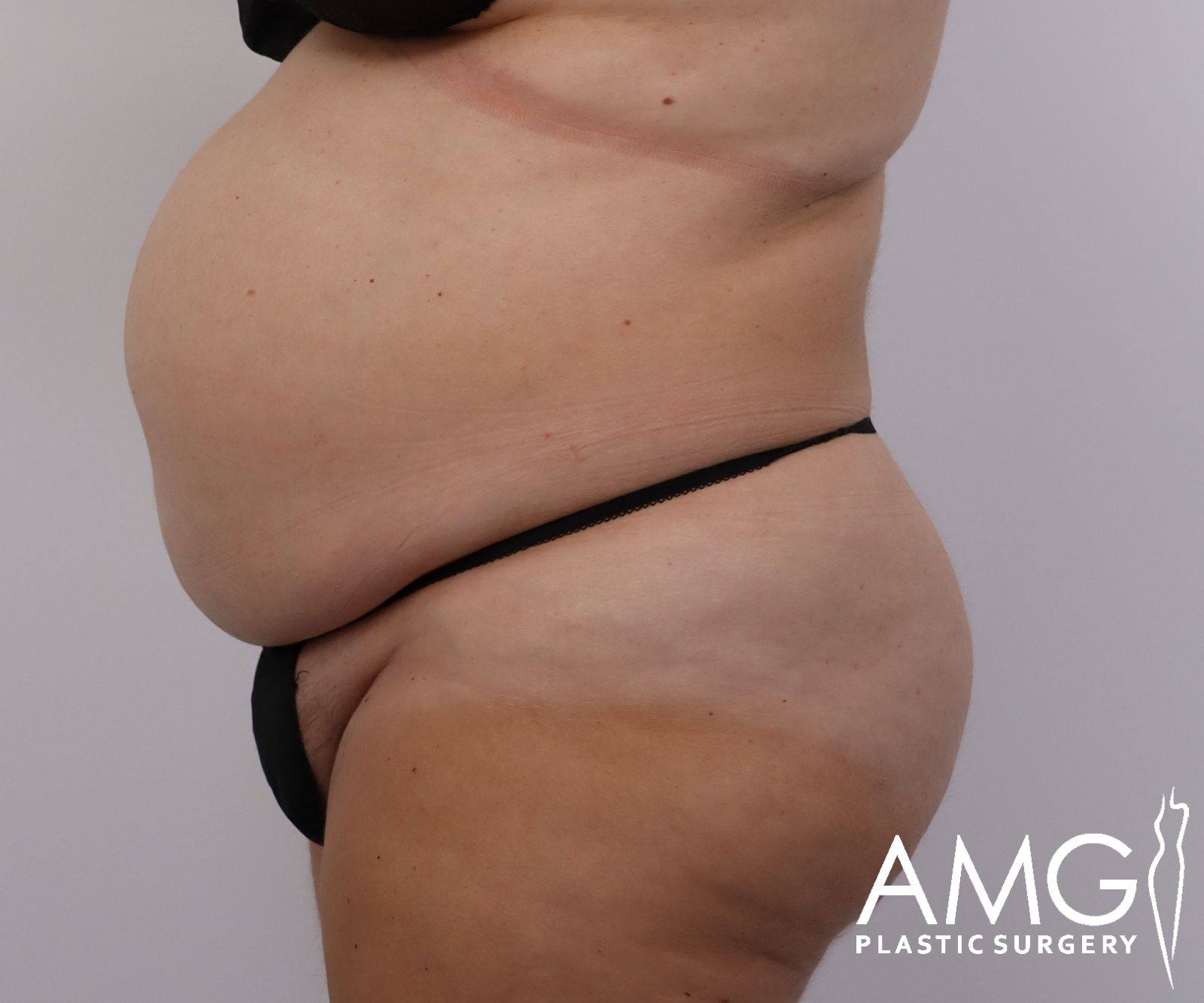 Abdomen before tummy tuck surgery – left side view, AMG Plastic Surgery