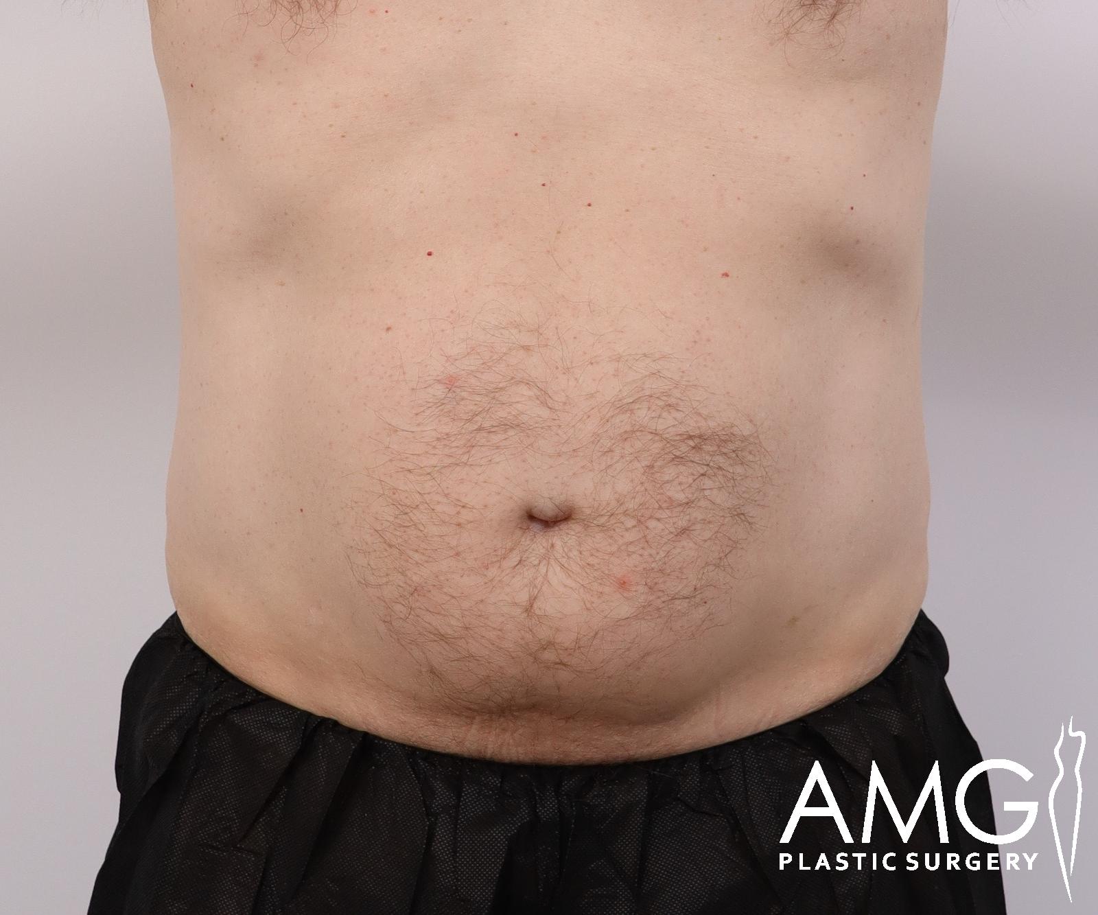 Abdomen before tummy tuck surgery – front view, AMG Plastic Surgery