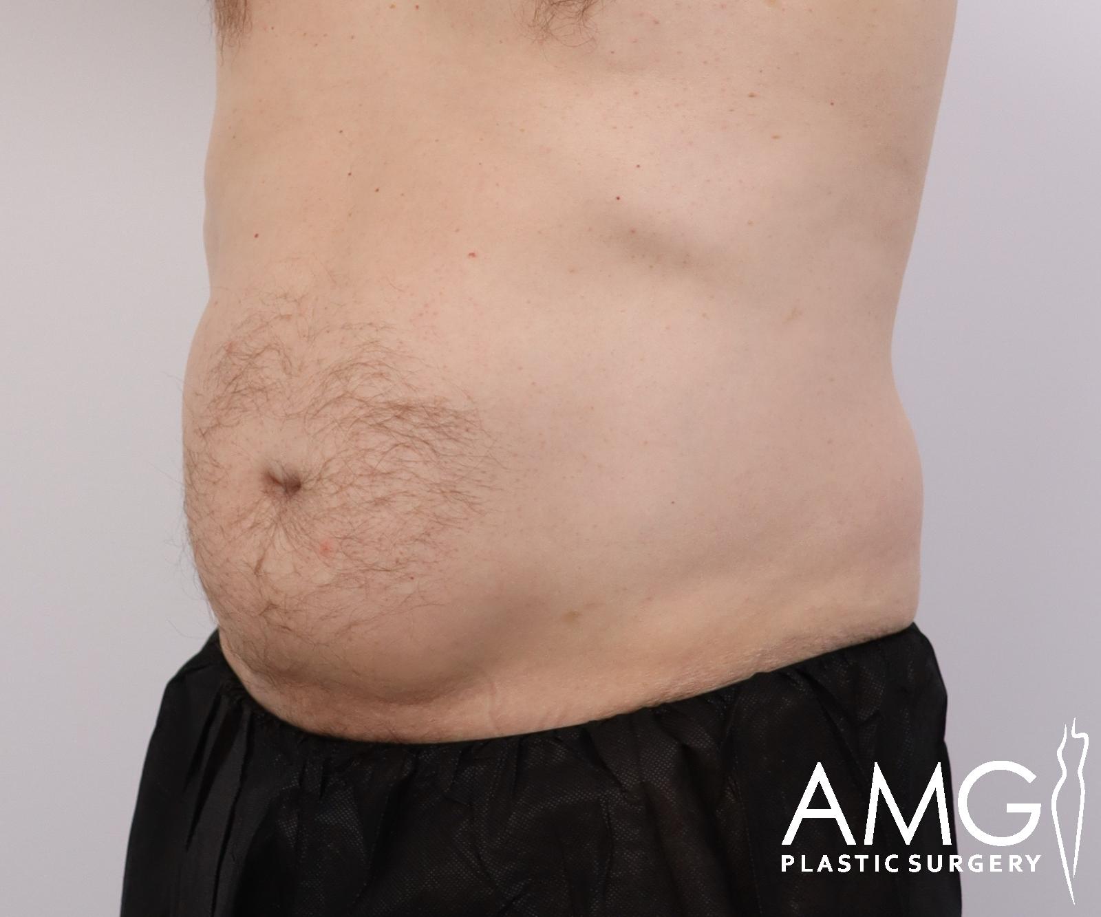 Abdomen before tummy tuck surgery – left oblique view, AMG Plastic Surgery