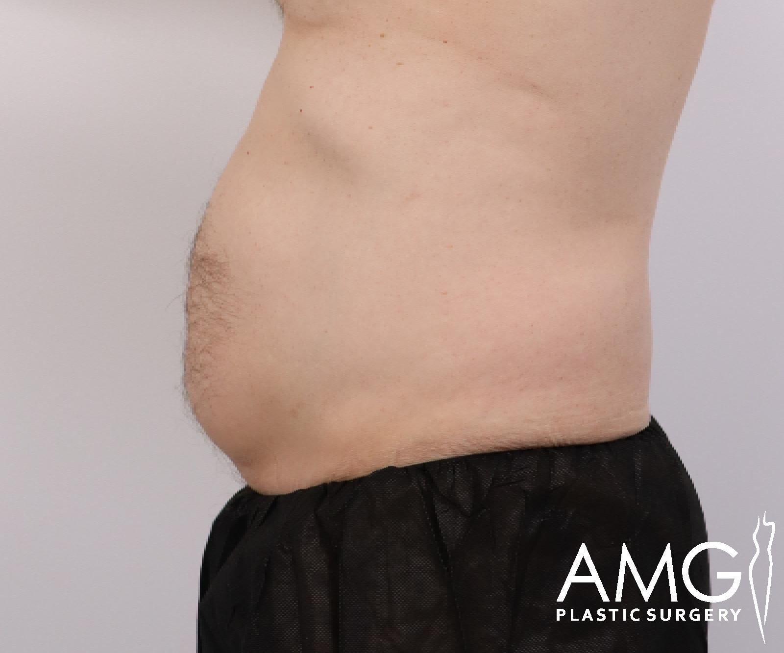 Abdomen before tummy tuck surgery – left side view, AMG Plastic Surgery