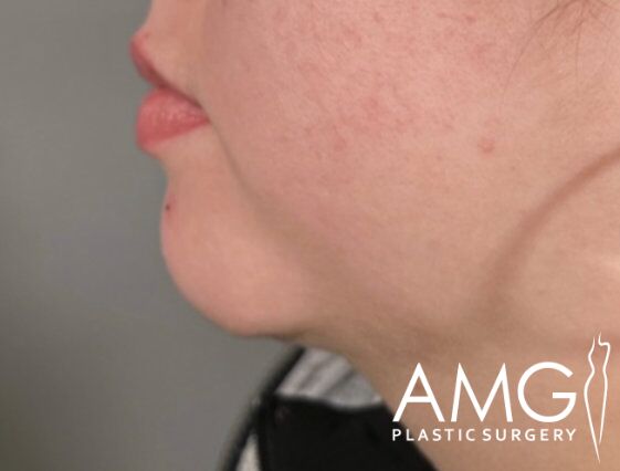 Close-up side profile of a person's chin showing skin texture and a slight double chin, with "AMG Plastic Surgery" logo in the corner.