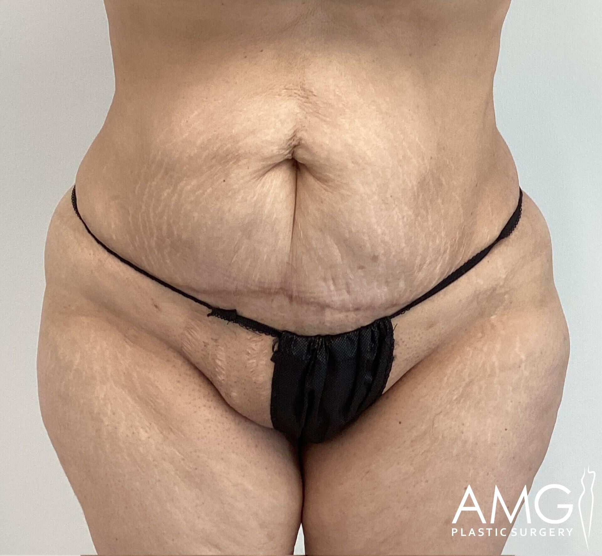 A close-up of a person's midsection, showing abdominal skin with stretch marks and slight sagging. The individual is wearing a black garment. The image has "AMG Plastic Surgery" logo.