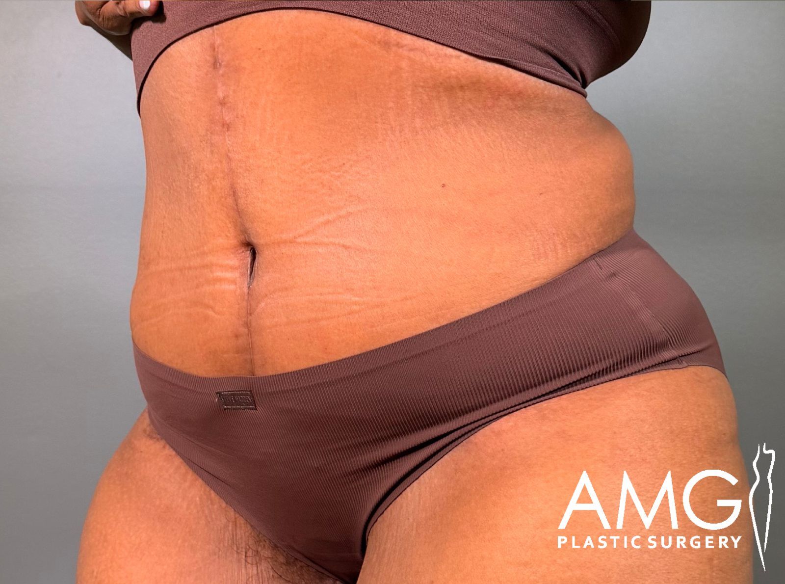 Left oblique view of a woman's abdomen after fleur-de-lis tummy tuck showing a flatter, more contoured abdomen with a visible vertical scar, AMG Plastic Surgery.