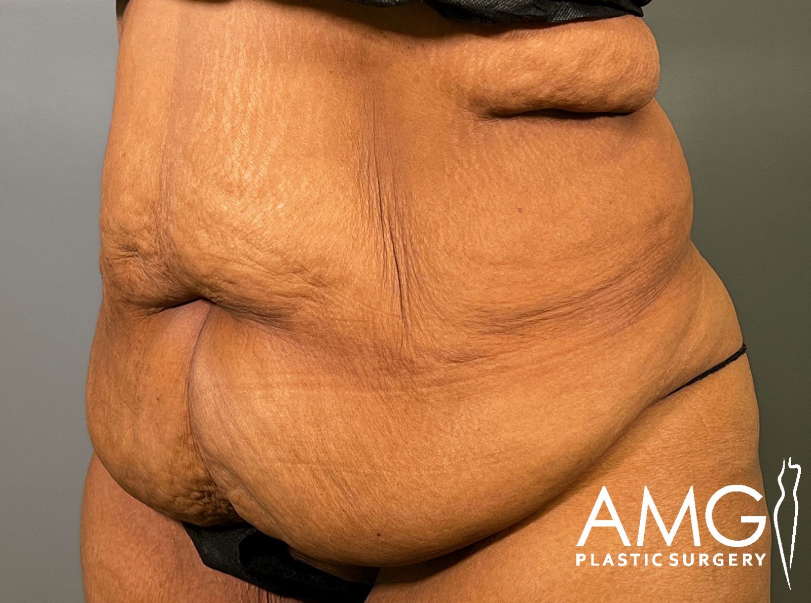 Left oblique view of a woman's abdomen before fleur-de-lis tummy tuck showing excess skin and reduced abdominal contour, AMG Plastic Surgery.