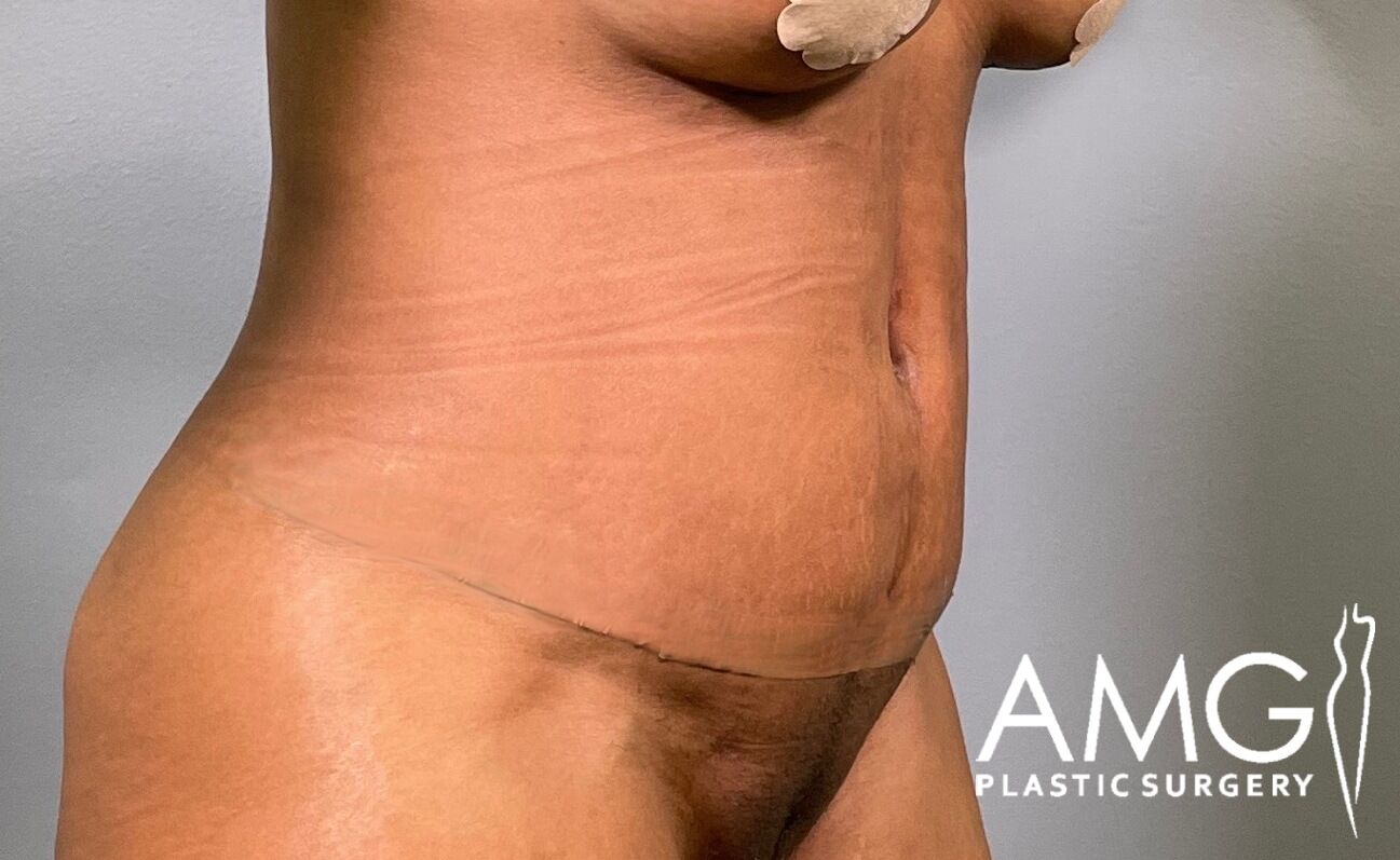 Tummy Tuck after surgery – right oblique view, AMG Plastic Surgery