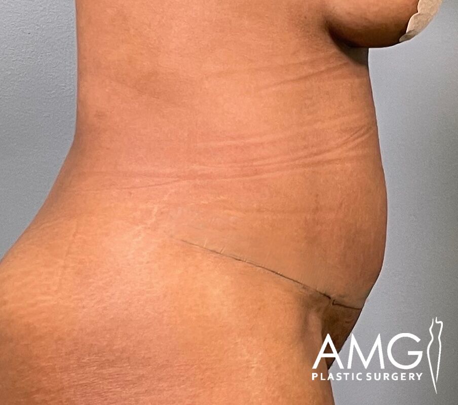 Tummy Tuck after surgery – right side view, AMG Plastic Surgery