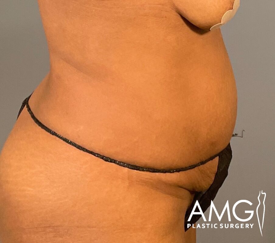 Tummy Tuck before surgery – right side view, AMG Plastic Surgery