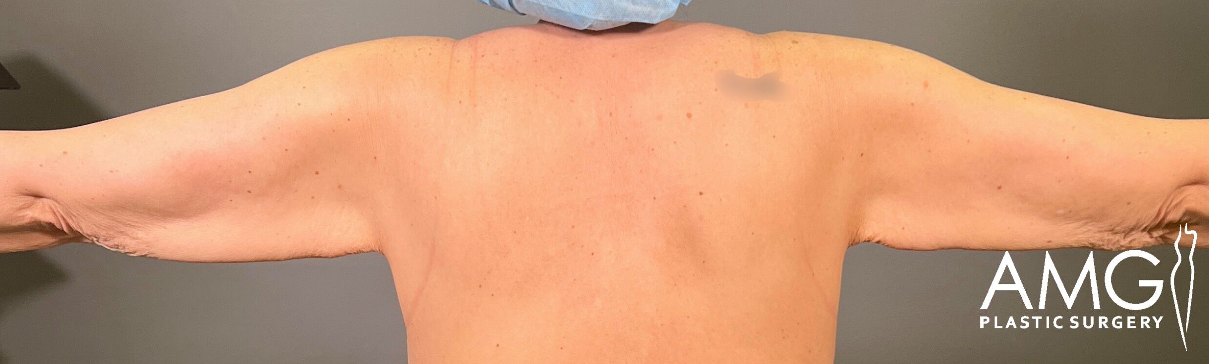 Upper Body Lift before surgery – back view, AMG Plastic Surgery